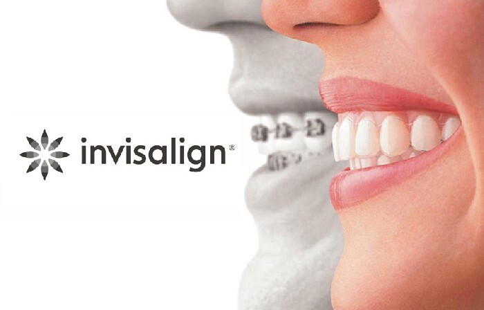Invisalign :: Rovnátka Uherské Hradiště